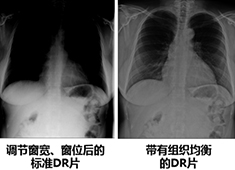 影響醫(yī)用X射線影像設備成像質(zhì)量的主要指標和因素