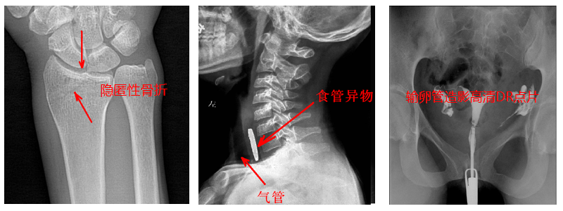 動態(tài)DR機準(zhǔn)確點片